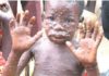 31 Monkey Pox Cases In Lagos, Ekiti, Ogun, Others